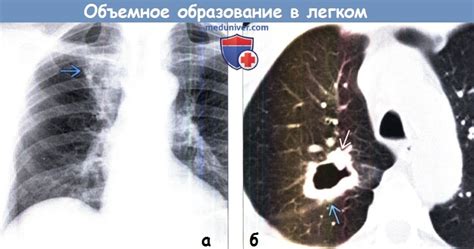 Что такое гомогенное образование в легком?