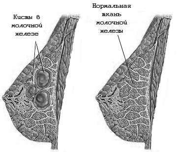 Что такое густое содержимое кисты молочной железы?