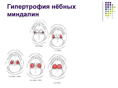 Что такое гэр 2 степени у ребенка