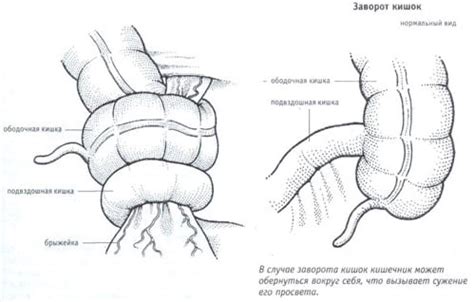 Что такое заворот кишок: причины, симптомы и лечение
