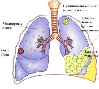 Что такое закрытая форма туберкулеза легких?