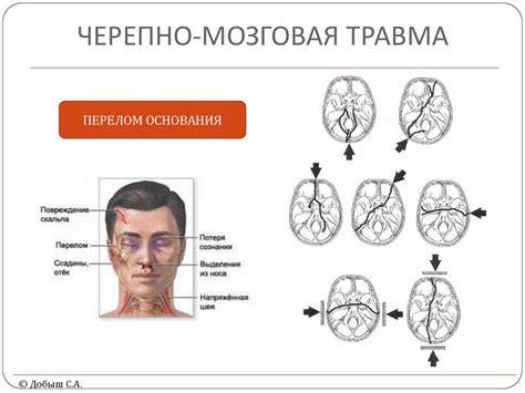 Что такое закрытая черепно-мозговая травма и как ее распознать?