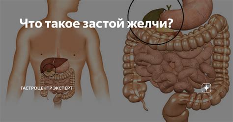 Что такое застой желчи?