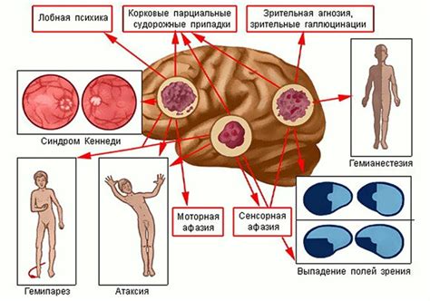 Что такое злокачественная опухоль головного мозга?