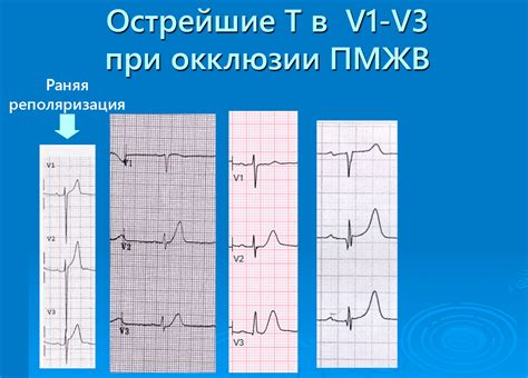 Что такое зубец р на ЭКГ?