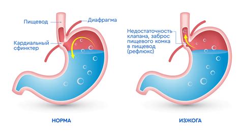 Что такое изжога?