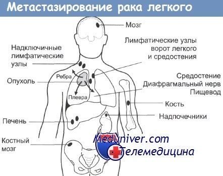 Что такое инфратенториальные очаги?