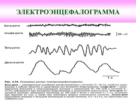 Что такое ирритативный тип ЭЭГ