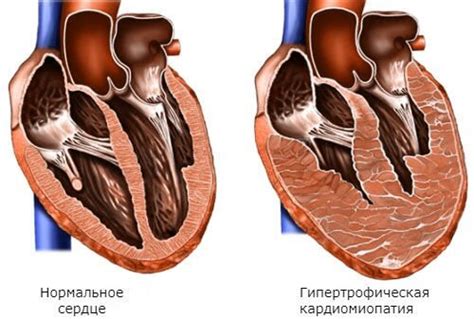 Что такое истощение сердечной мышцы?