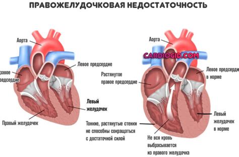 Что такое кардиальная недостаточность 1 степени?