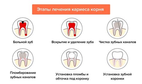 Что такое кариес корня зуба?