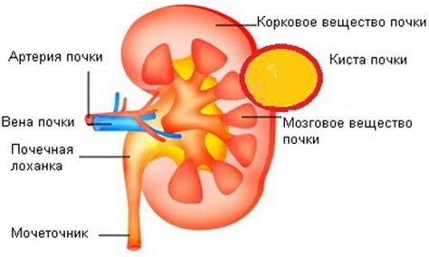 Что такое киста паренхимы правой почки?