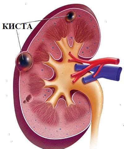 Что такое киста почек?