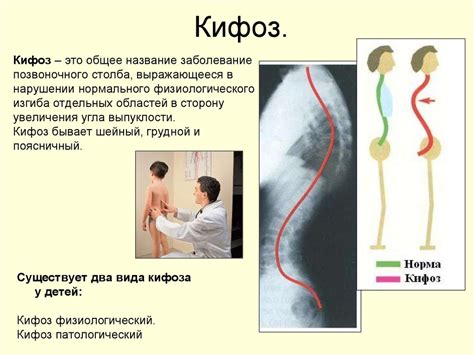 Что такое кифотическая установка и как она влияет на здоровье?