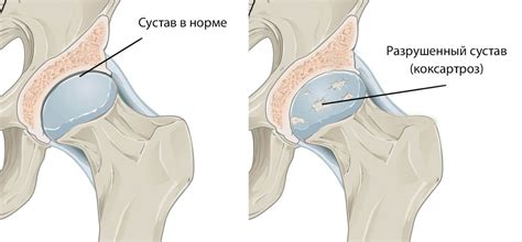 Что такое коксартроз тазобедренного сустава