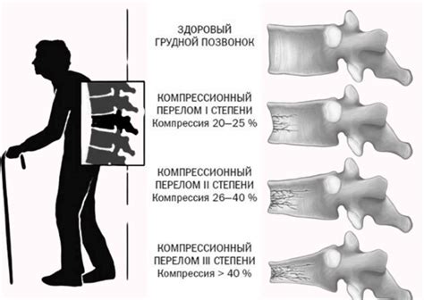 Что такое компрессионные переломы позвоночника