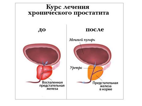 Что такое конкременты и какова их роль в развитии калькулезного простатита?