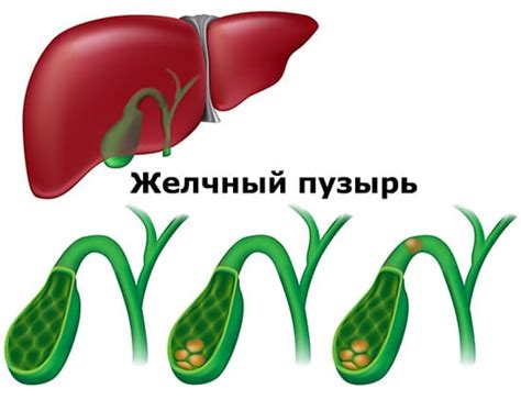 Что такое лабильный перегиб желчного пузыря?