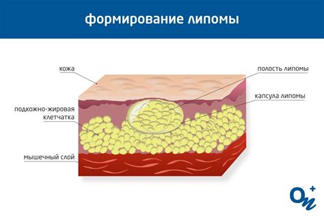 Что такое липома?