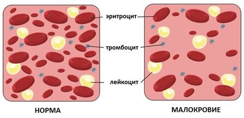 Что такое малокровие?