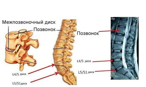 Что такое медианная грыжа диска?