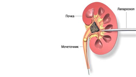 Что такое микролит почек?