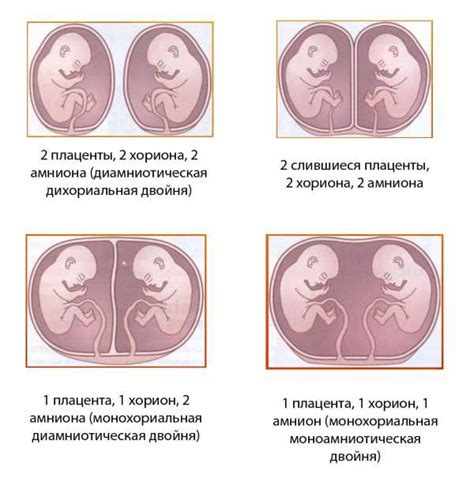 Что такое монохориальная биамниотическая двойня?