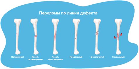 Что такое мос-перелом?