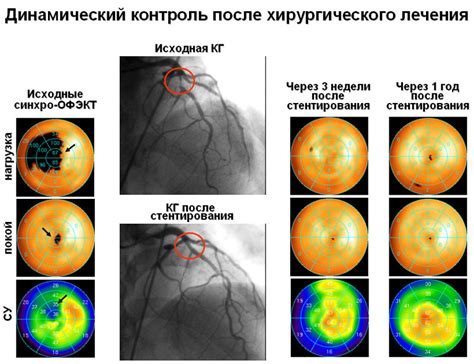 Что такое нагрузочная сцинтиграфия миокарда и как она применяется?