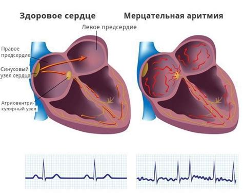 Что такое наджелудочковая аритмия?