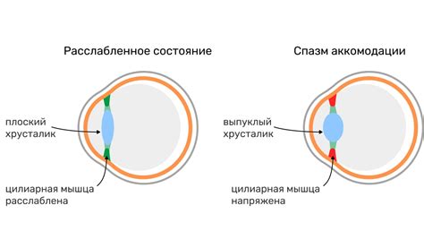 Что такое нарушение аккомодации и как с ним бороться