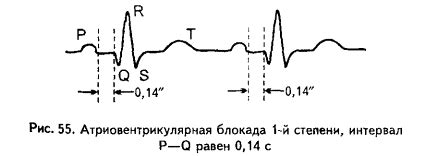 Что такое нарушение атриовентрикулярной проводимости?