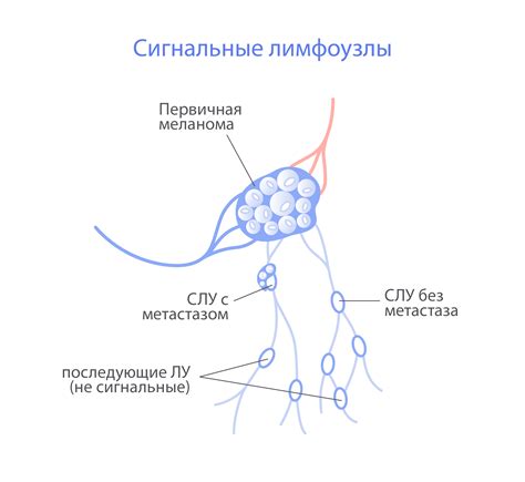 Что такое нарушение дифференцировки лимфоузла?