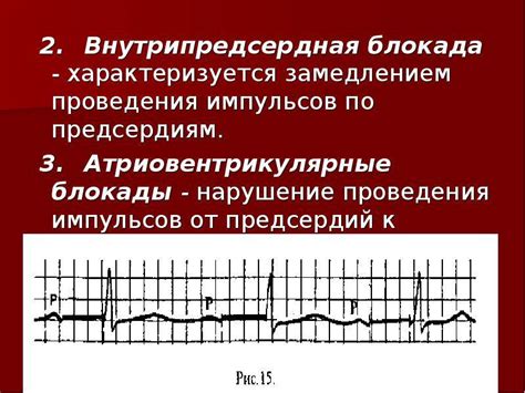 Что такое нарушение межпредсердной проводимости?