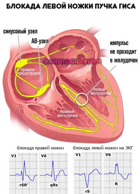 Что такое нарушение предсердной проводимости?