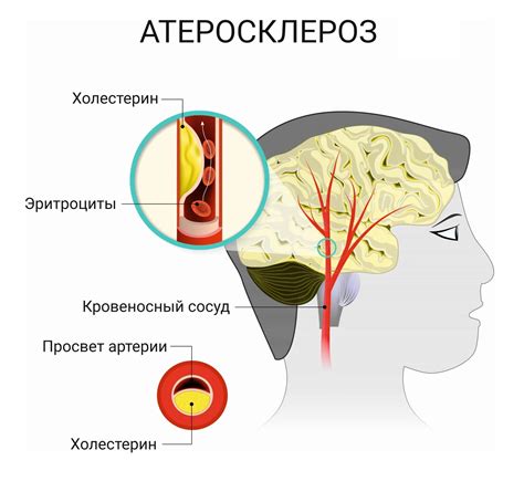 Что такое начальный атеросклероз?