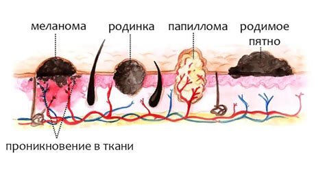 Что такое невус и как он выглядит?