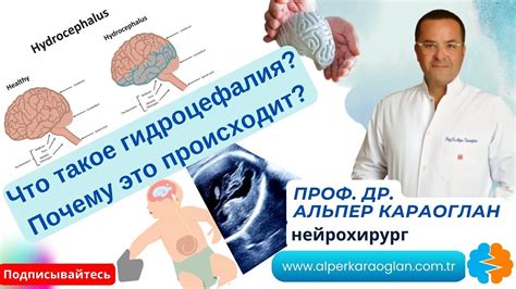 Что такое невыраженная гидроцефалия?