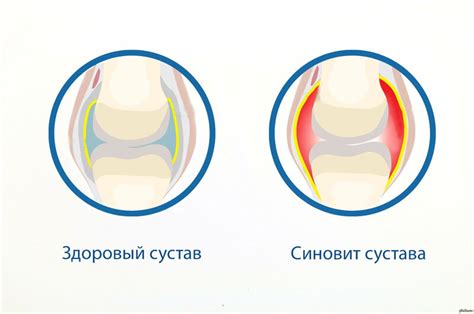 Что такое незначительный синовит?