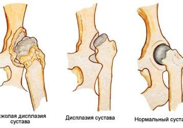 Что такое незрелость тазобедренных суставов и как она проявляется?