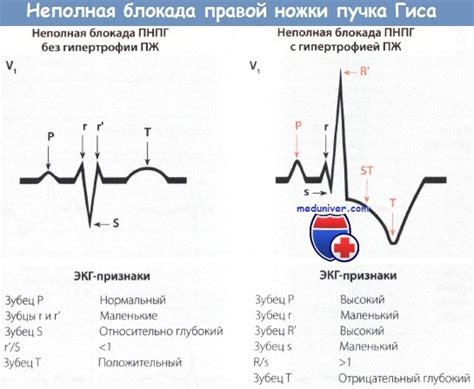 Что такое неполная блокада ПНПГ?