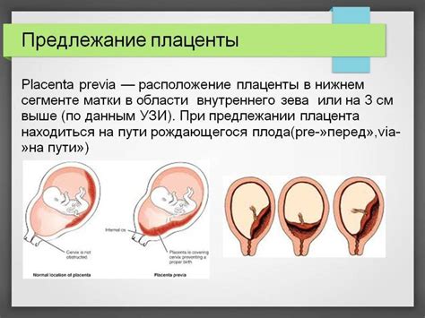 Что такое неполное предлежание хориона?