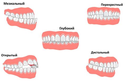 Что такое неправильный прикус зубов?