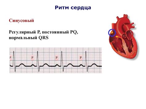 Что такое неправильный ритм QRS?