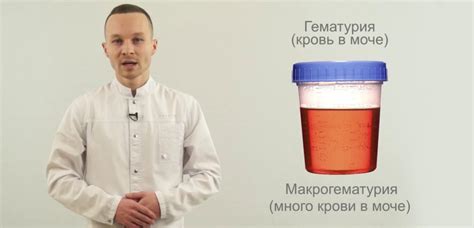 Что такое неспецифическая гематурия?