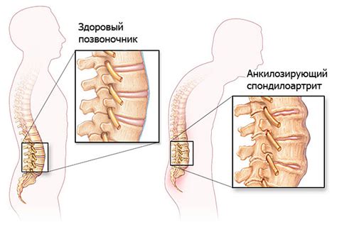 Что такое неспецифический спондилоартрит?