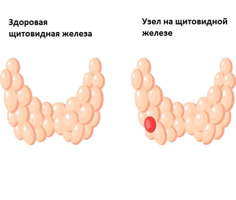 Что такое нетоксический одноузловой зоб?