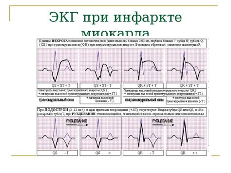 Что такое нижний инфаркт миокарда на ЭКГ