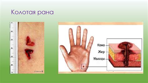 Что такое осадненные края раны?