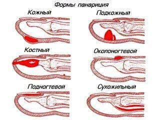 Что такое панариций?